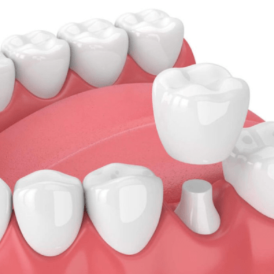 DENTAL CROWNS