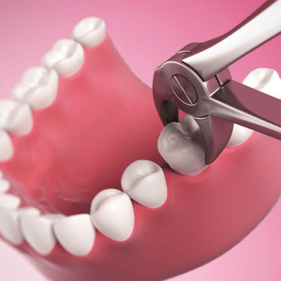 TEETH EXTRACTIONS