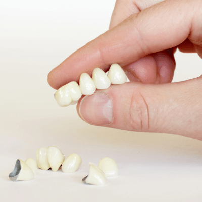 DENTAL BRIDGES