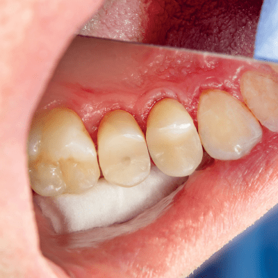 COSMETIC FILLINGS
